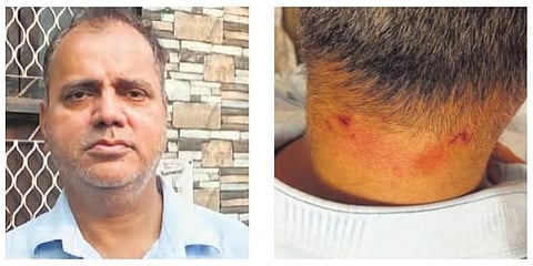 Hemant; and injury marks on the back of his neck. (Photo| Express)