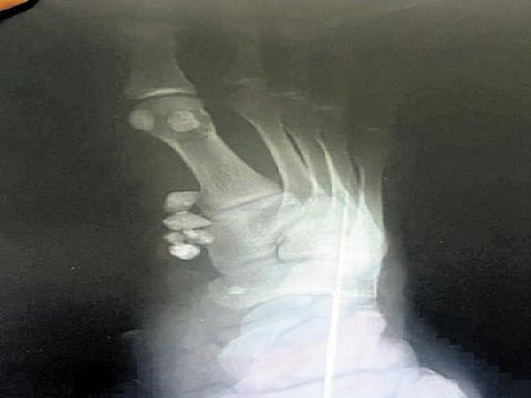 X-ray revealing stones within the stitched portion | Express