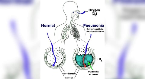 Pneumonia (Wikimedia Commons)