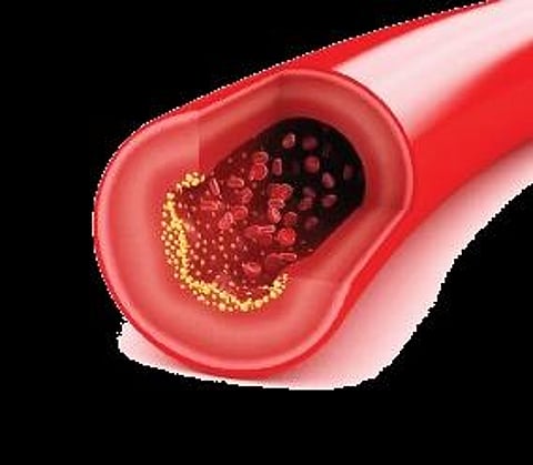 Good cholesterol—good for brain?