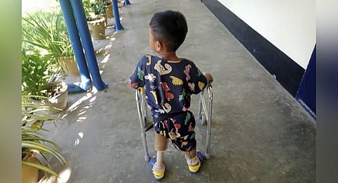 A young landmine victim learns to use his new prosthetic limbs at Hpa-An Orthopedic Rehabilitation Center in Hpa-An township, Karen State, Myanmar. (Photo | AP)