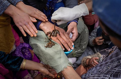 Leech therapy being administered in Kashmir on 'Navroz'. (Photo | PTI)