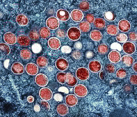 FILE: Colorized transmission electron micrograph of monkeypox particles (Photo | AP)