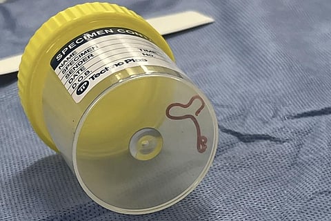 A neurosurgeon investigating a patient's mystery neurological symptoms in an Australian hospital was surprised to pluck a 3-inch wriggling worm from her brain. (Photo | AP)