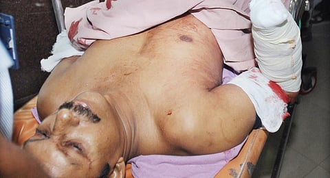 T J Joseph, professor of Thodupuzha Newman College, whose palm was chopped off by Muslim Extremists in 2010.(File Photo | Express)