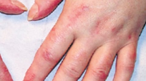 Delving into Dermatomyositis