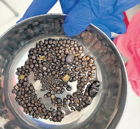 The removed kidney stones