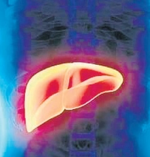 Representative Image of hepatitis A liver infection