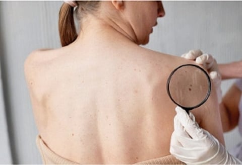 Exploring skin cancer awareness