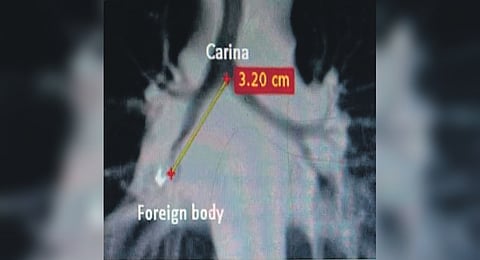 The boy was playing with the 5-cm-long and 2-cm-wide bulb when he accidentally swallowed it.