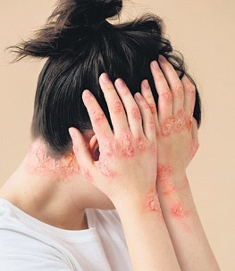 According to a 2016 study, the prevalence of the disease in India was approximately 2.8%.