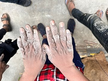 The burnt hands of a child rescued from the factory.