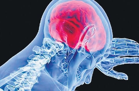 Representative image