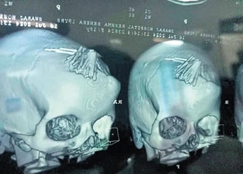 The scan of the victim’s skull shows the presence of needles