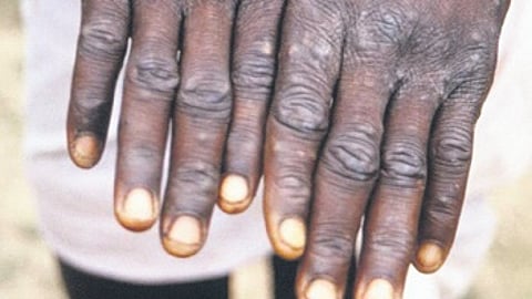 The Mpox, previously known as MonkeyPox is a viral disease caused by the monkeypox virus.
