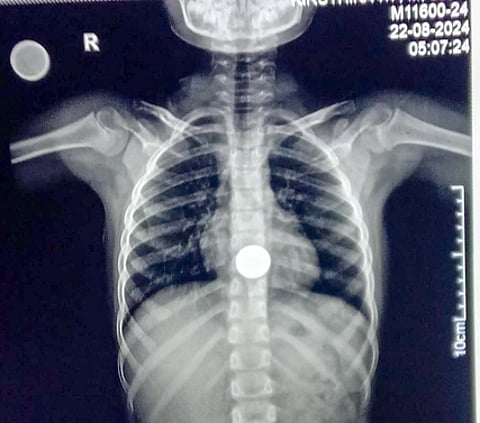 Doctors at the Tirupattur Government Hospital successfully removed a Rs 5 coin from the food pipe of a seven-year-old girl, Kanishree, on Sunday.