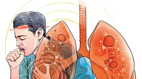 Incense, pigeons, pet dander may cause lung diseases