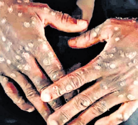 A 26-year-old man who returned from the UAE tested positive for mpox on Friday.