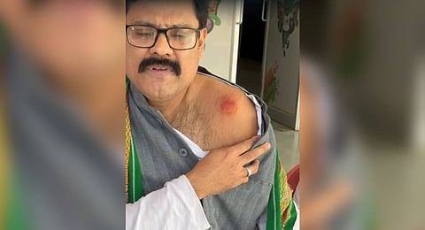 Congress leader Ashwin Kumar Mahanta showing where he was “bitten”.