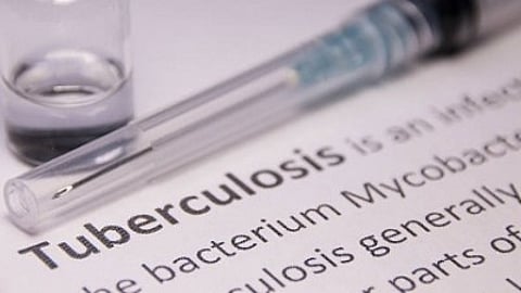 The report said India alone accounted for 28% of deaths globally caused by TB among HIV-negative people, while the country accounted for 25% of deaths among people with or without HIV in 2024.