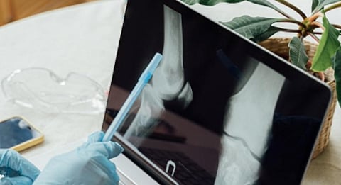 The bioink is designed to address the challenges with bone grafting and implants.