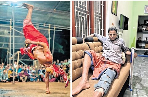 Shanu Peruvannan during a captivating theyyam performance (R) Shanu with his
injured leg