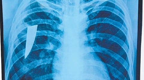 A team of doctors at CTVS department in MKCG medical college and hospital removed a piece of a knife stuck in the chest of a youth since last 3 years.