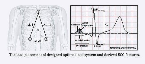 NIT-Rourkela research team designed the ALS. The system uses a modified arrangement to enhance the recording of atrial electrical activity.