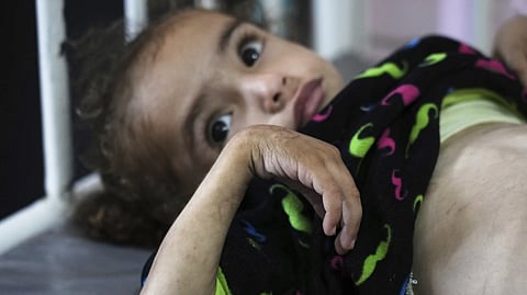 Mayar Al-Arja, 2, who suffers from malnutrition, lies on a bed in a clinic in Nasser hospital, Khan Younis, Gaza, Wednesday, May 21, 2025.