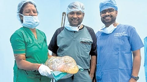 Surgeons with the massive tumour.