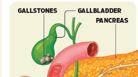 Children too young for gallstones? Not anymore!