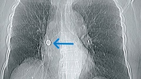 In a rare and complex intervention, doctors retrieved the pin using a minimally invasive bronchoscopic technique involving a Fogarty balloon catheter