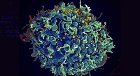This colorized electron microscope image provided by the U.S. National Institutes of Health shows a human T cell, in blue, under attack by HIV, in yellow, the virus that causes AIDS.