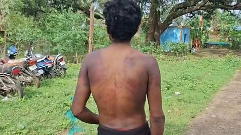 The alleged assault left Shivpal Uike with several injuries on his back.
