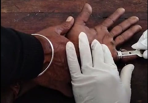 Using a small steel cutter, the team removed the ring within 30 minutes.