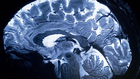 amoebic meningoencephalitis is a rare brain infection caused by Naegleria fowleri
