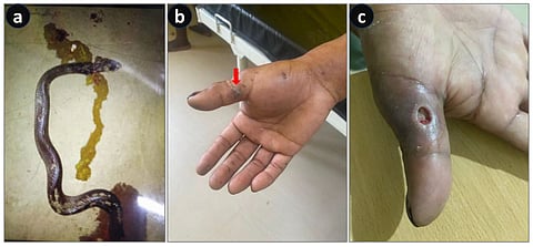 Dead cobras and kraits can also envenom, experts in Assam have found during case studies.