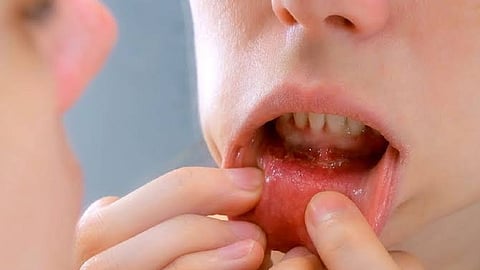 Oral cancer: Pain men brush off