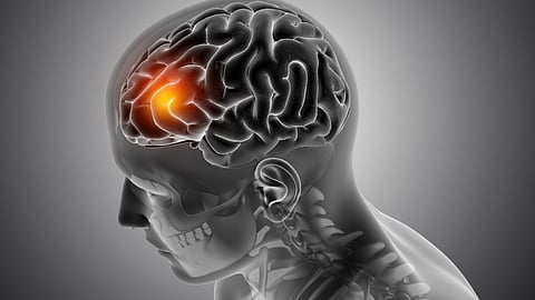 Why every minute matters in stroke care