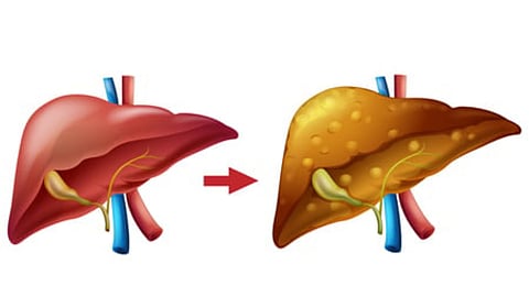 Metabolic-Dysfunction-Associated Steatotic Liver Disease