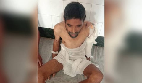 A destitute patient at SCB medical college and hospital.