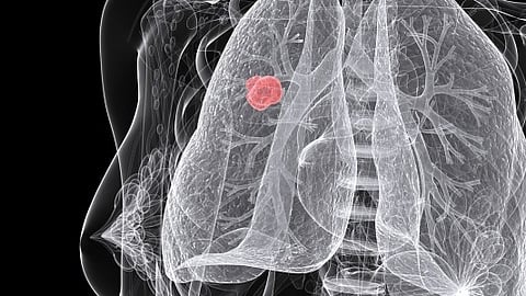 Lung cancer accounts for one of the most cases among cancer-related deaths in India