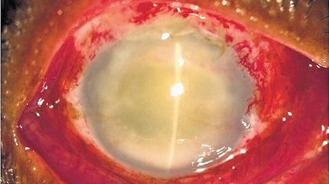 Researchers said eye infections occur when bacteria enter through minor injuries, foreign particles, environmental exposure or contact.