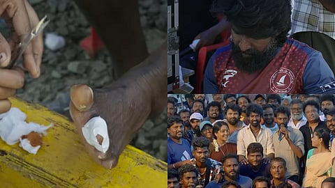 (L) Soori's injury from Mandaadi shoot; (R) Soori with the entire film's team