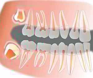 Wisdom behind wisdom tooth