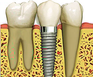 All about dental implants