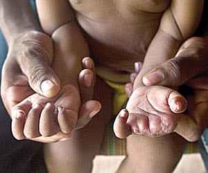 Madvi Mukesh, 18 months, is missing three fingers, lost when security forces allegedly killed his mother.