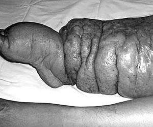 Major breakthrough in treating filariasis