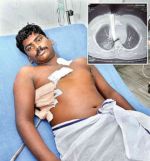 Knife removed from chest of bar employee