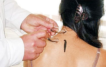 Leech Therapy Draws the First Blood